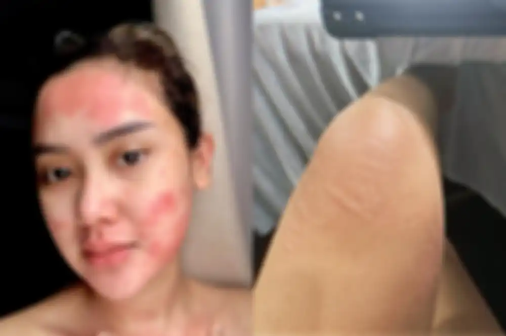 Kondisi kulit Cita Citata