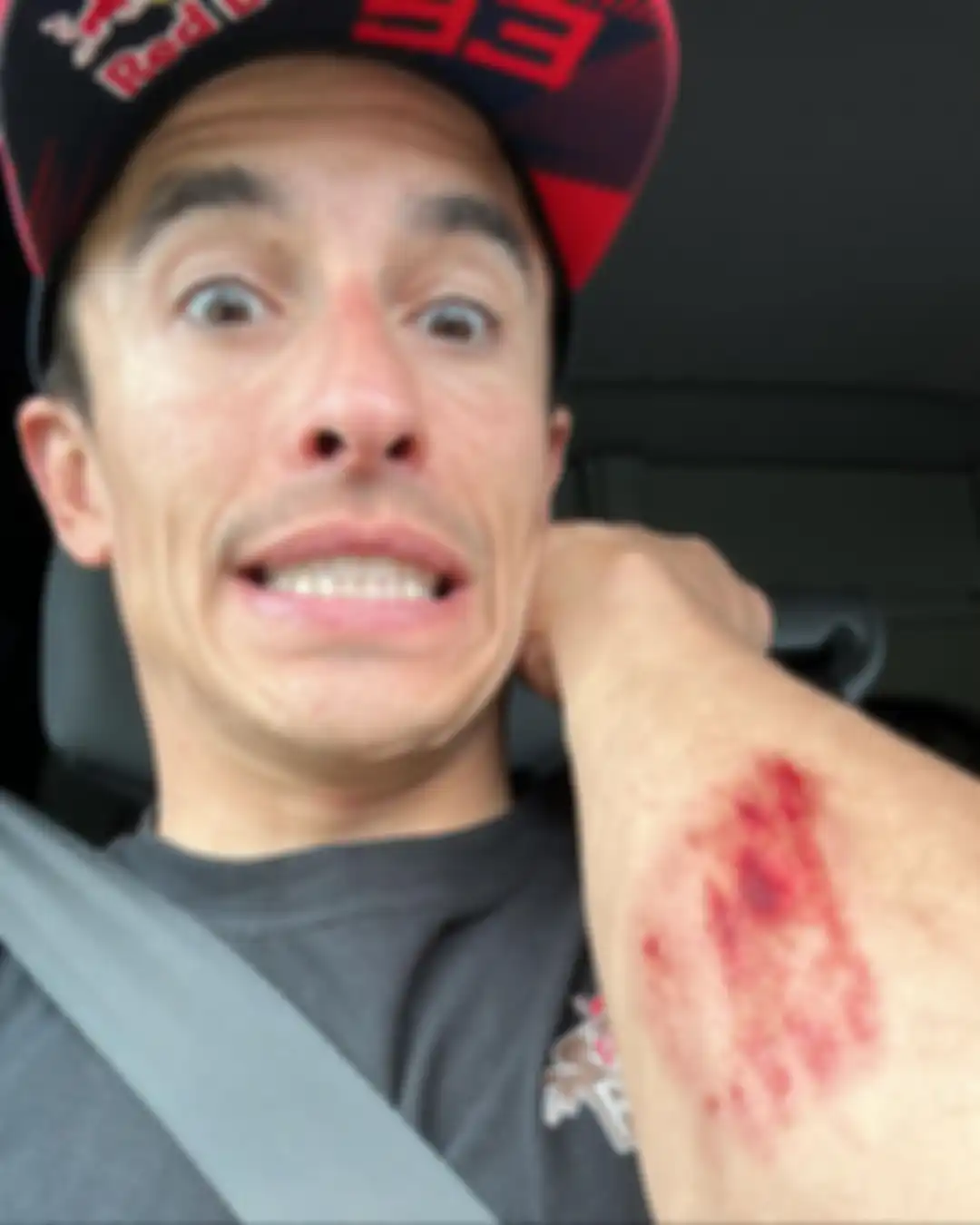 Marc Marquez menunjukkan kondisi tangan kirinya yang lecet.