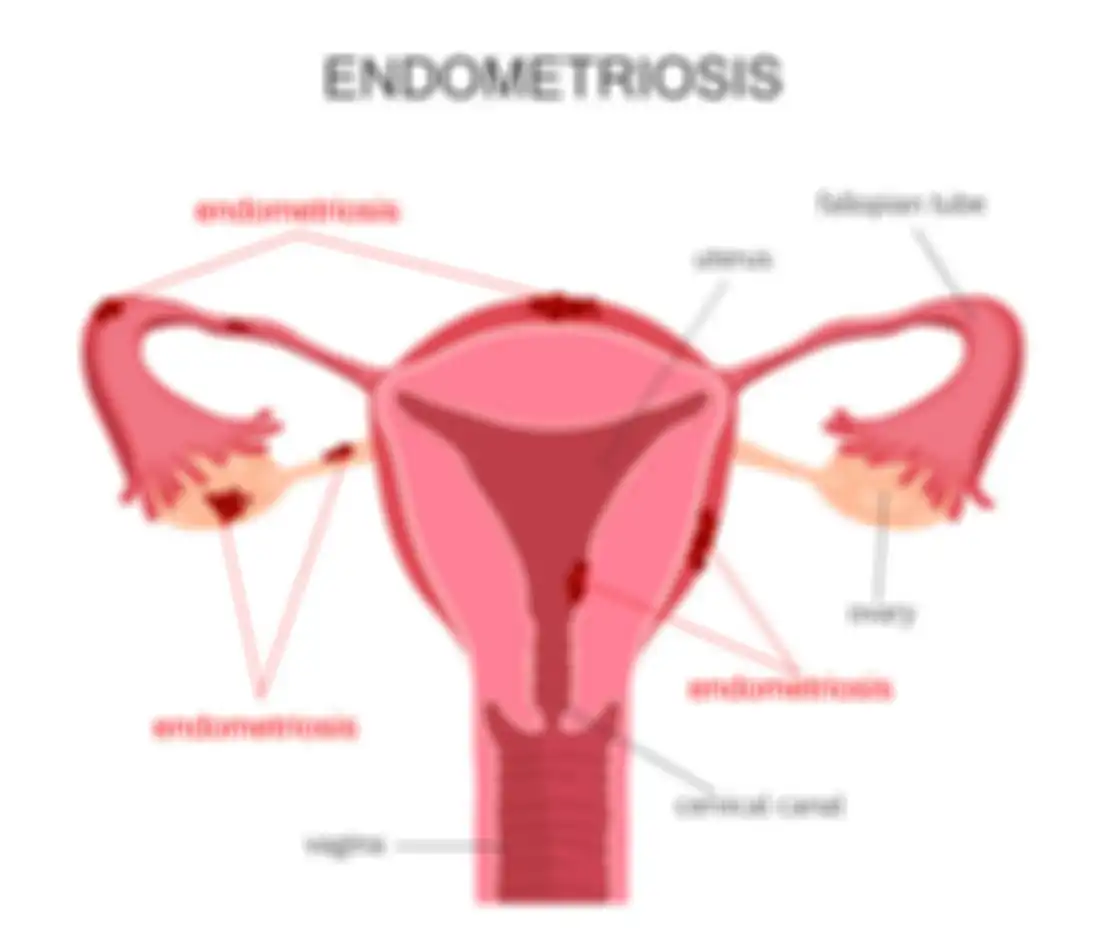Kenali Endometriosis, Penyakit Yang Pernah Dialami Zaskia Sungkar dan Delia Septianti