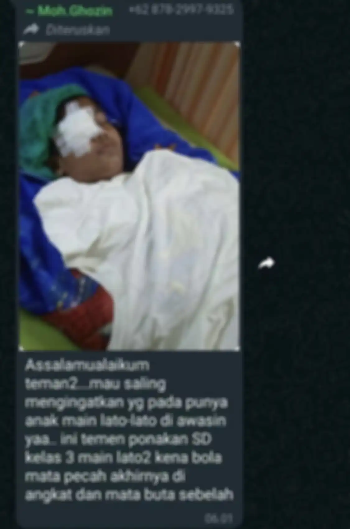 Foto kondisi anak yang menjadi korban pecahan dari bola plastik lato-lato. Kenali cara main yang benar.
