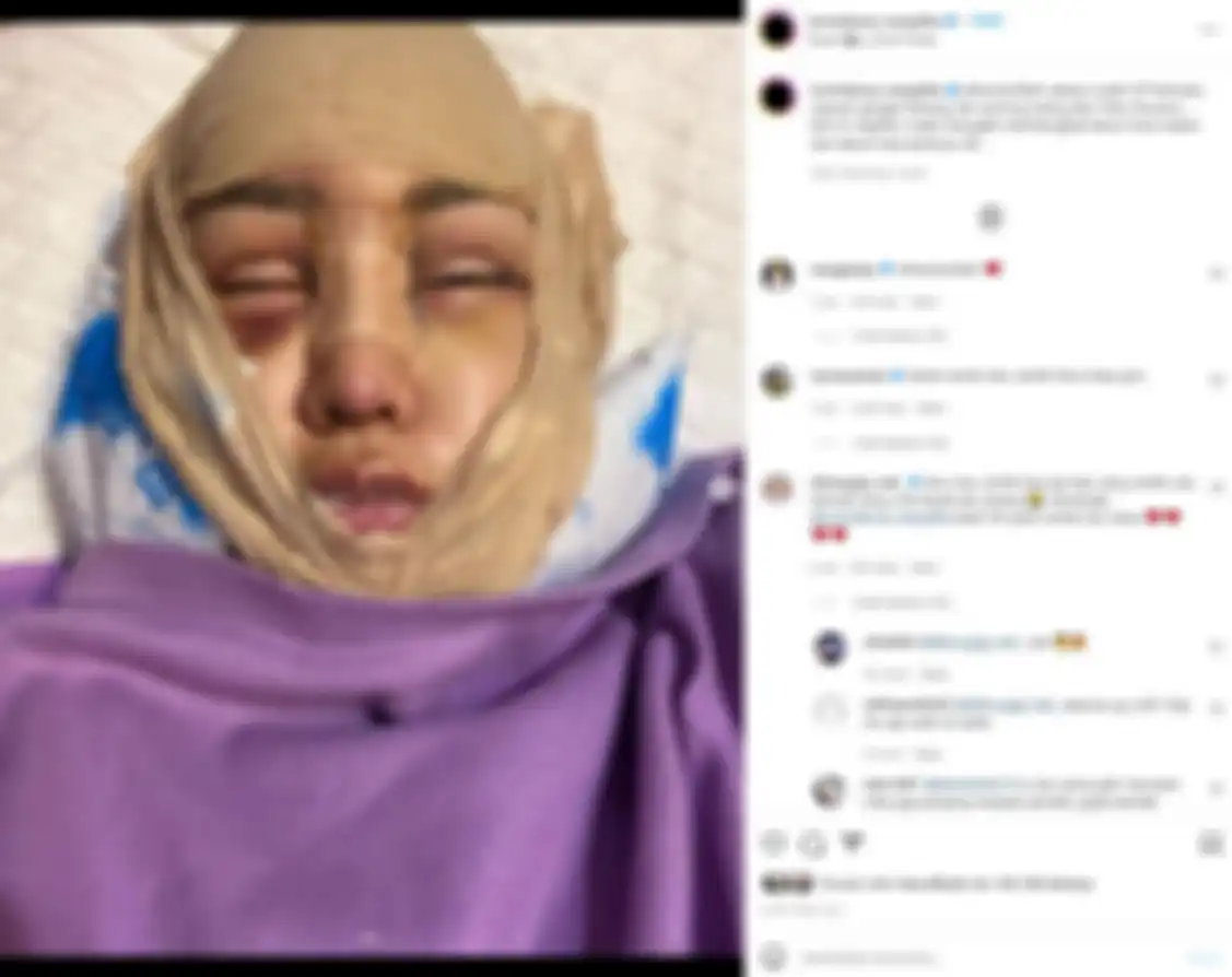Wajah Lucinta Luna pasca operasi dinilai makin ngeri