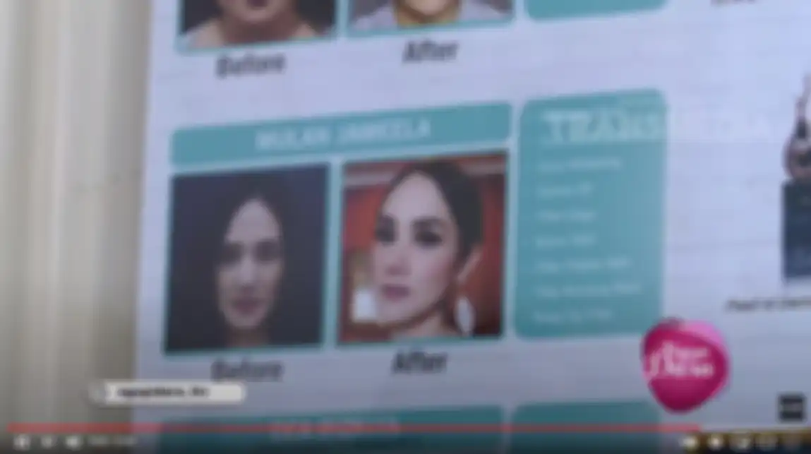 Wajah Mulan Jameela sebelum dan sesudah menjalani perawatan