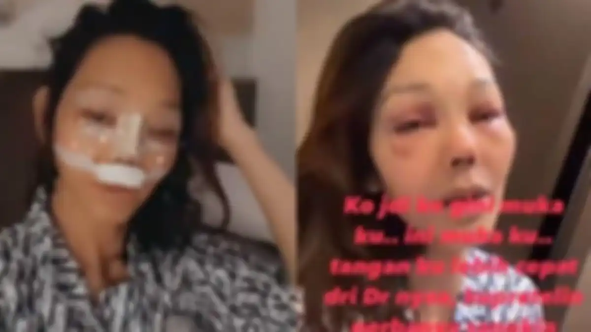 Bunda Corla operasi plastik
