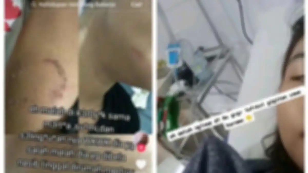 Pergoki suami selingkuh, wanita malah digigit pelakor hingga infeksi   