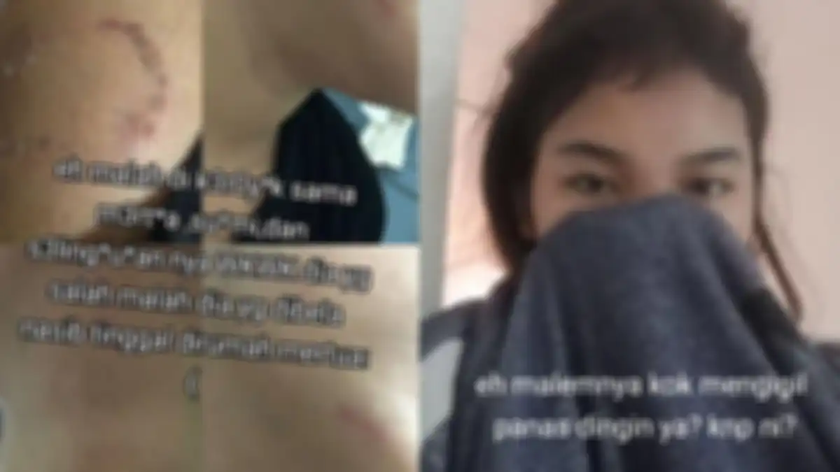Pergoki suami selingkuh, wanita malah digigit pelakor hingga infeksi  