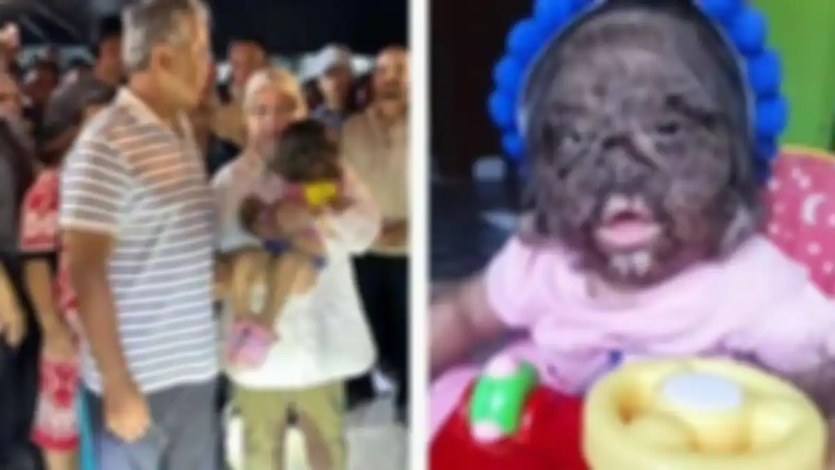 Viral sosok gadis kecil bernama Missclyen, disebut anak dari surga oleh Raja Malaysia, mengidap Werewolf Syndrome.