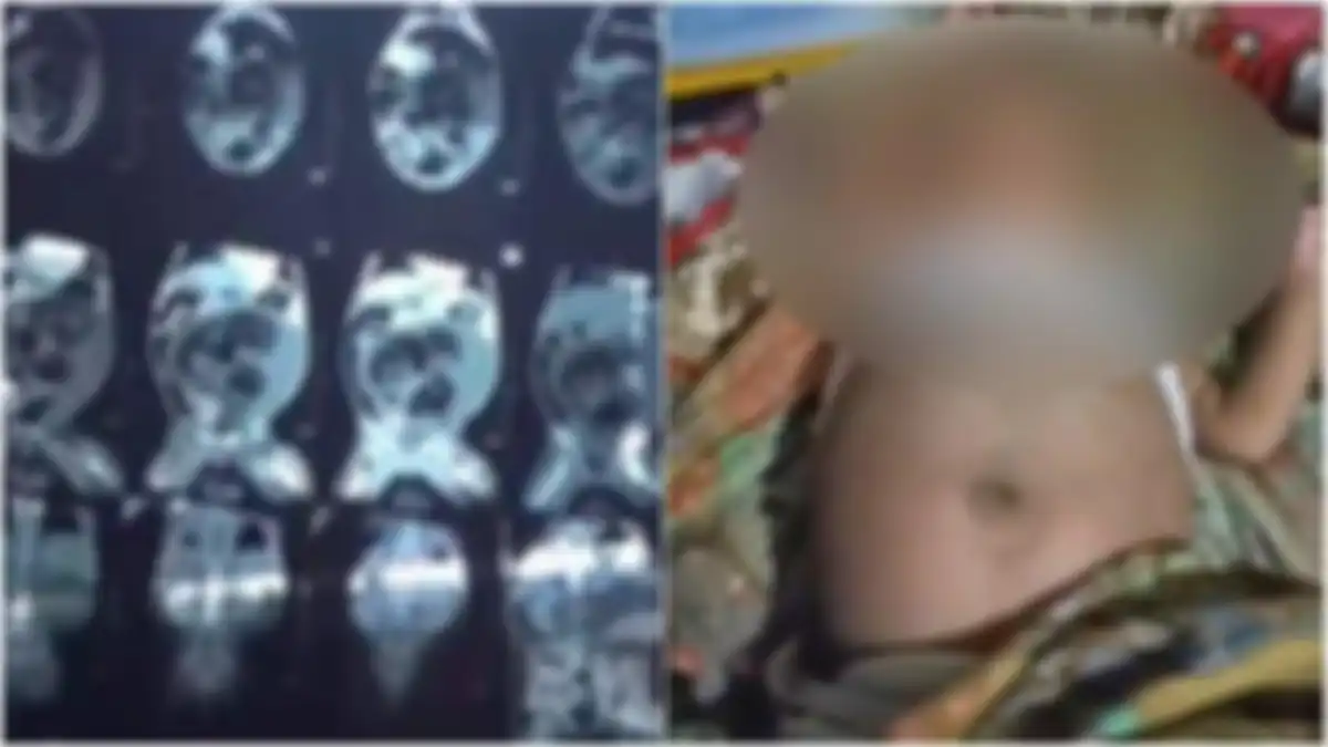 Hasil rontgen perut bayi laki-laki di Pesisir Selatan yang hamil, berisi janin saudara kembar. 