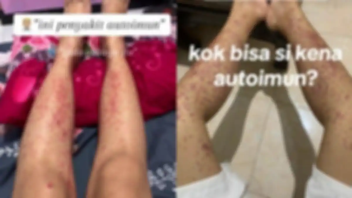 Kisah wanita bernama Della warga Sidoarjo, Jawa Timur menderita penyakit autoimun. 
