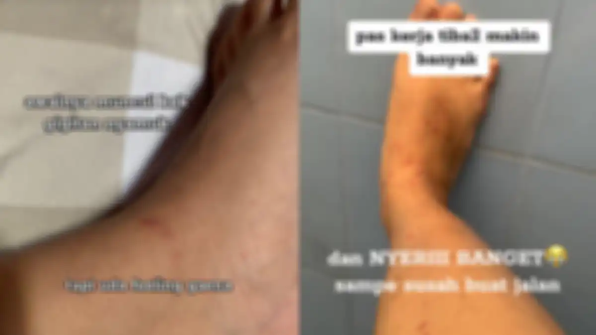 Cerita Della derita autoimun.