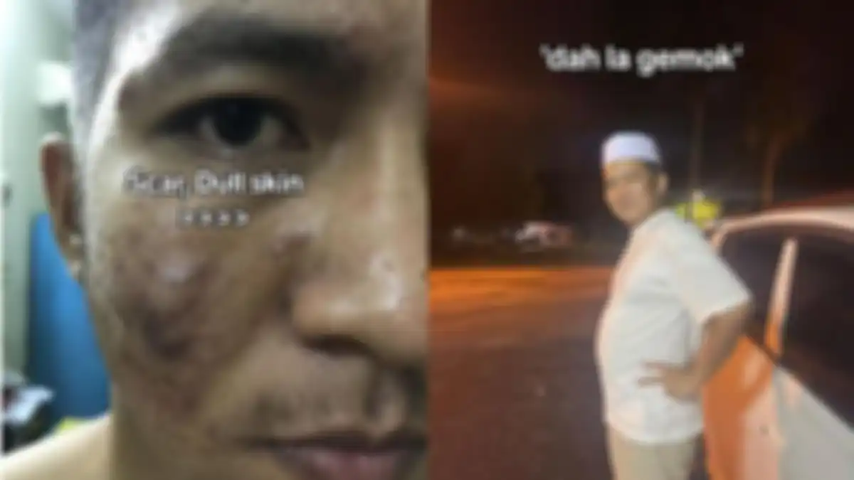 Pria bernama Anas Aiman ​​​​membagikan dua foto lawas yang memperlihatkan wajahnya penuh jerawat.