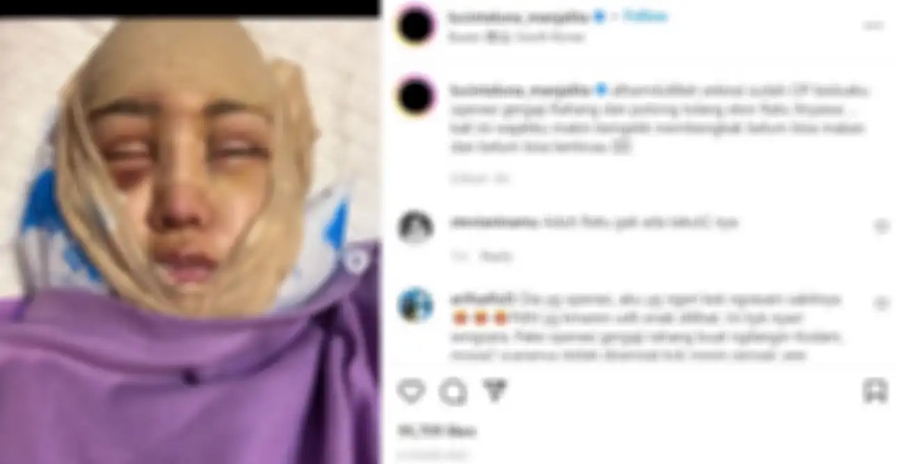 Lucinta Luna kembali melakukan operasi plastik 