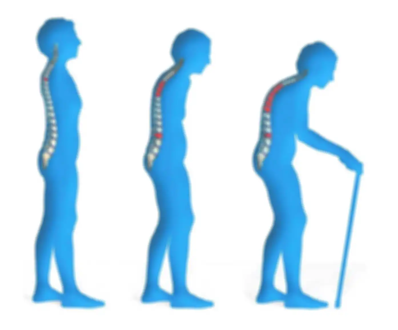osteoporosis