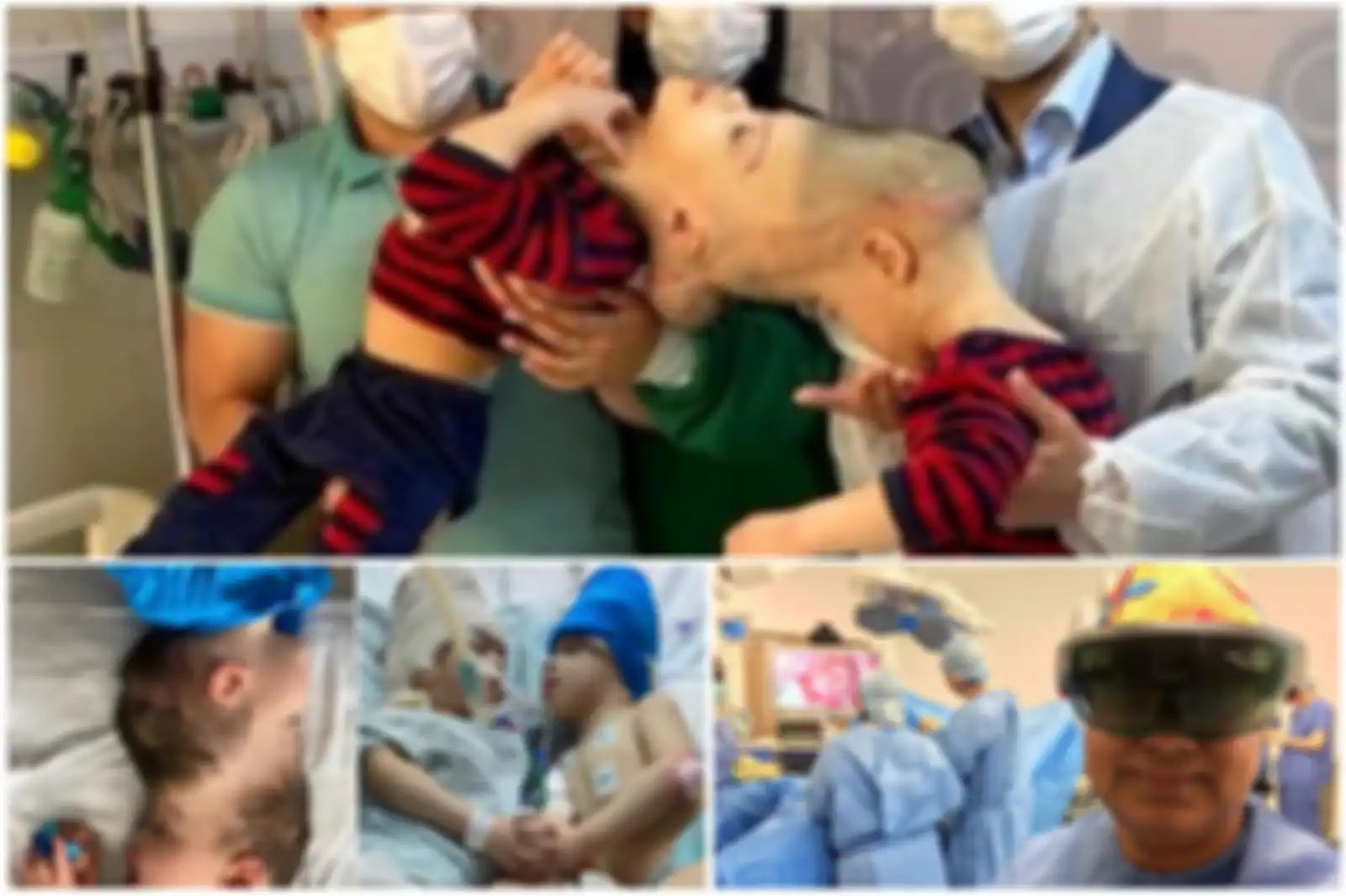 Bayi kembar siam cranopagius berhasil dipisahkan melalui operasi virtual dokter Brasil-Inggris.