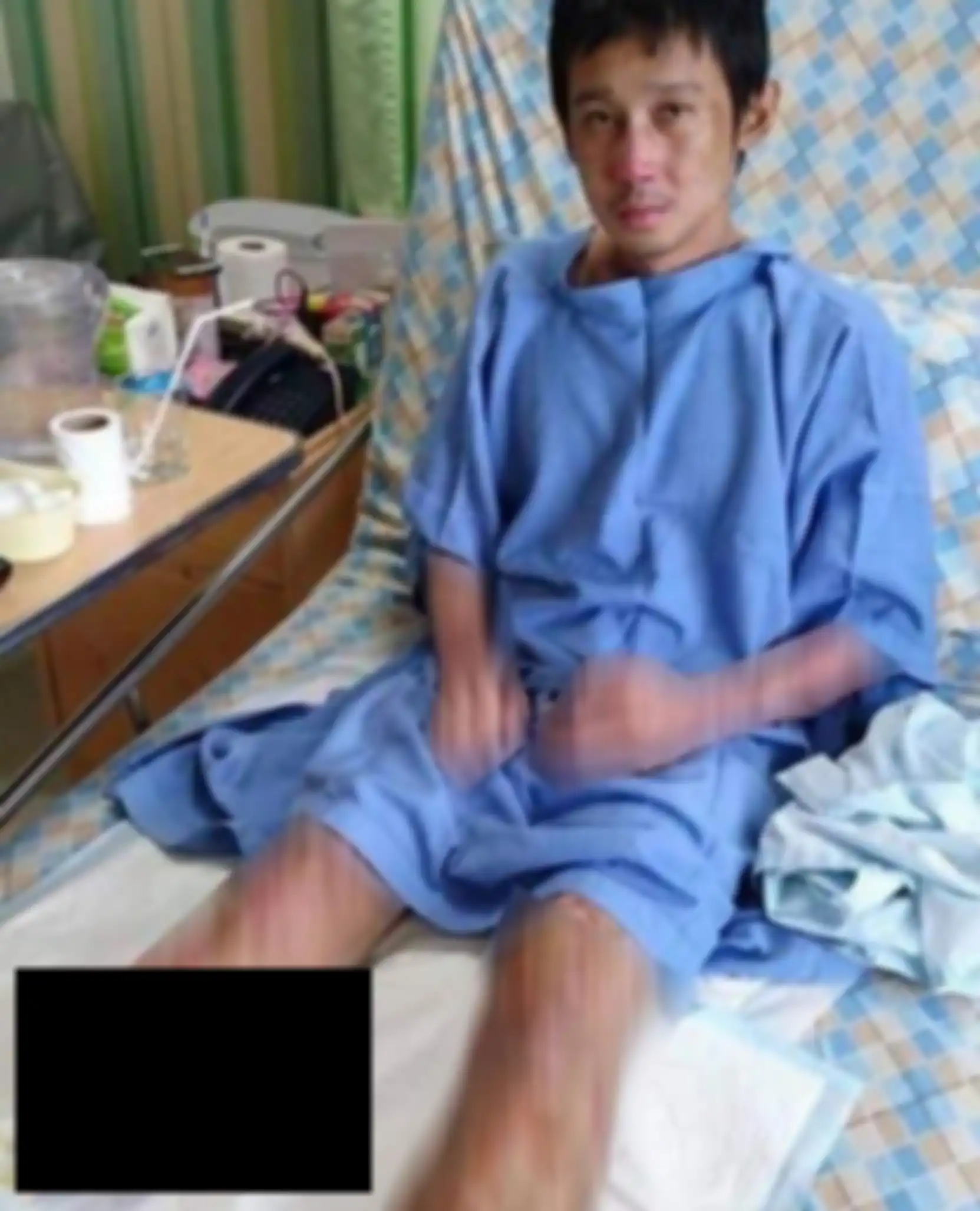 Pria ini harus mengamputasi kakinya karena infeksi parah akibat santap olahan darah babi.