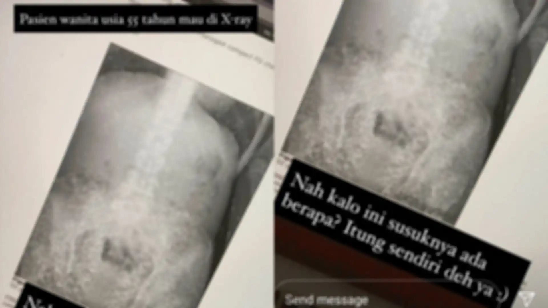 Ratusan susuk terlihat pada x-ray pasien wanita usia 55 tahun.