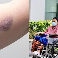 Ani Yudhoyono Tak Sadarkan Diri: Ini 5 Gejala Leukemia yang Sering Kali Diabaikan, Salah Satunya Memar di Tubuh