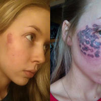 Molly Martinson, Blogger Kecantikan yang Mendapat Luka Bakar di Wajahnya Setelah Operasi Laser