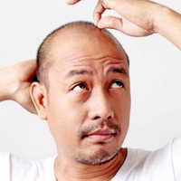 Tips Hentikan Kebotakan