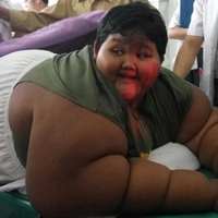 Arya Permana, Bocah Berbobot 189,5 Kg yang Gemar Konsumsi Mi Instan