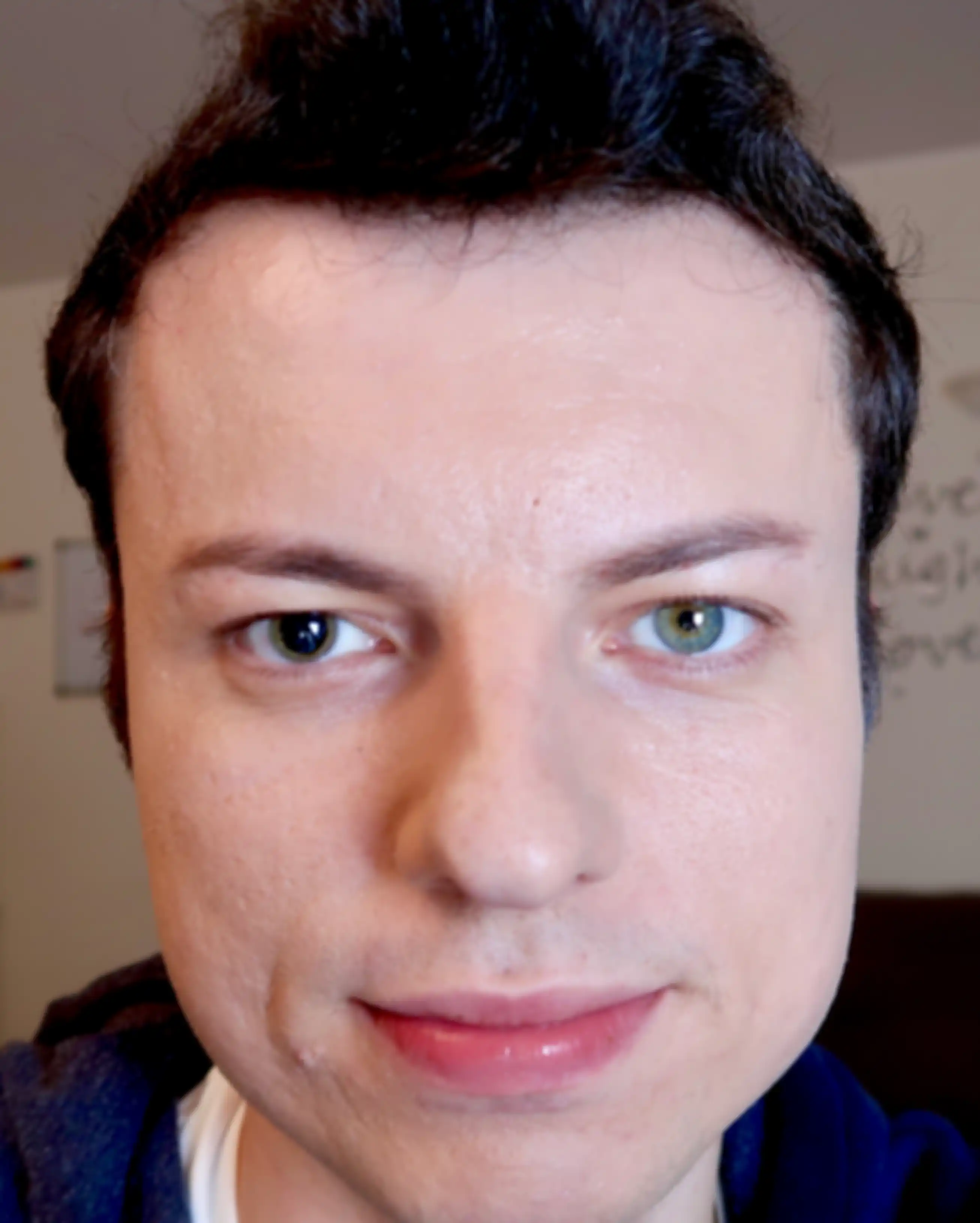 Anisocoria