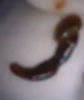 Bentuk lintah berukuran 5 cm yang berhasil keluarkan dari hidung Wong.