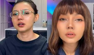 Rina Nose Akui Derita Post-op Blues, Depresi Pasca Oplas Hidung