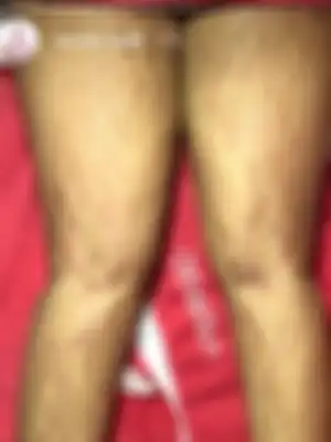 Kondisi pasien yang mengalami akibat penggunaan lotion pemutih abal-abal.