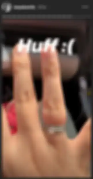 Jari tangan Tasya yang bengkak mengalami lecet