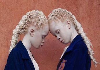 Ingat Lara dan Mara Bawar? Dua Kembar Negro Asal Brazil yang Unik, Begini Mereka Sekarang