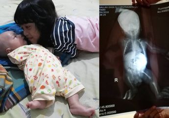 Perjuangan Athallah, Pengidap Sindrom Meromelia yang Lahir Tanpa Tangan Kanan dan Hanya Punya Tiga Jari