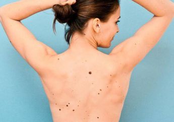 5 Bahan Alami ini Ampuh Hilangkan Tahi Lalat di Tubuh, Sudah Tahu?