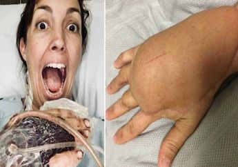 Jari Manis Digaruk, Tangan Seorang Wanita Jadi Bengkak Sebesar Balon 