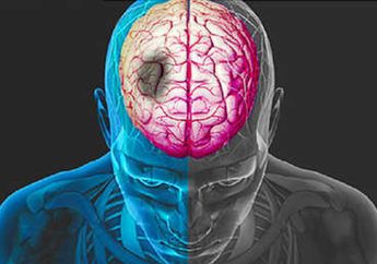 8 Gejala Umum yang Dialami Orang Sebelum Terkena Stroke, Perlu Waspada nih!