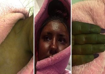 Pakai Krim Tanning Palsu, Kulit Wanita Ini Berubah Menyeramkan Mirip Hulk