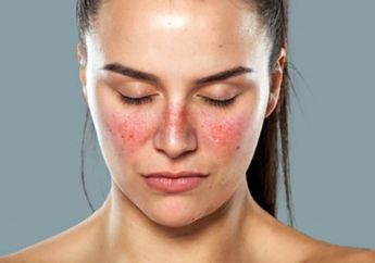 Penjelasan Dokter Tentang Kesehatan Janin pada Ibu Hamil yang Mengidap Penyakit Lupus