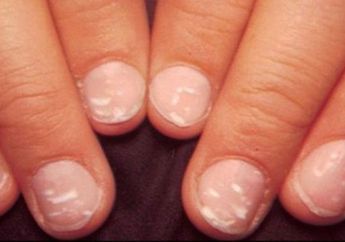 Banyak Mitos Tentang Munculnya Bintik Putih di Kuku, Ternyata Begini Penyebabnya