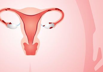 Kenali Endometriosis, Kondisi yang Bisa Mengancam Kesuburan Wanita, Sebetulnya Apa sih Itu?