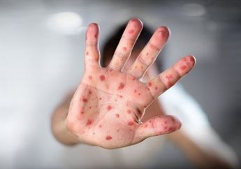 Kenali Gejala&nbsp;Penularan Campak Sebelum Terlambat, Salah Satunya Mirip Alergi?