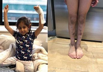 Dikira Lebam Biasa, Ternyata Gadis India Derita Kanker Ganas dengan Donor Terbatas