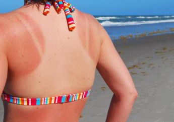 Ibuprofen Efektif Ringankan Radang Kulit Akibat Terbakar Matahari, Berikut Penjelasannya!