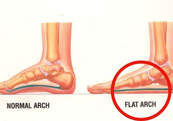 Mengenal Kondisi Kaki Datar, dari Penyebab, Bahaya, dan Pengobatannya
