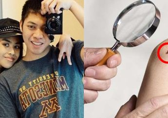 7 Ciri Orang yang Rentan Terkena Melanoma, Kanker Kulit Ganas yang Diderita Adara Taista