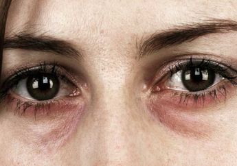 Ganggu Penampilan, Ternyata Ini Penyebab Kantong Mata Hitam Kerap Muncul