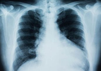 Waspada, Kanker Paru-paru Rentan Serang Wanita Ketimbang Pria, Ini Sebabnya