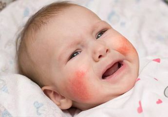 Slapped Cheek Syndrome, Ruam Kulit yang Berbahaya dan Mematikan, Kepoin yuk!