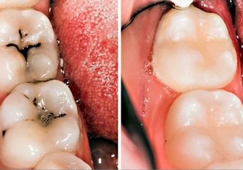 Sederhana dan Alami, Lakukan 6 Cara Mudah untuk Pulihkan Potensi Gigi Berlubang