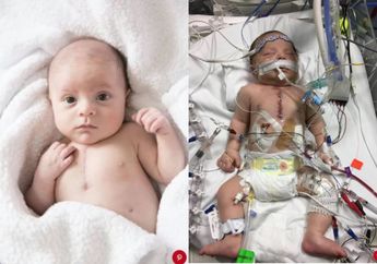 Divonis Meninggal Dunia, Bayi dengan Cacat Jantung Berhasil Lewati 12 Jam Operasi