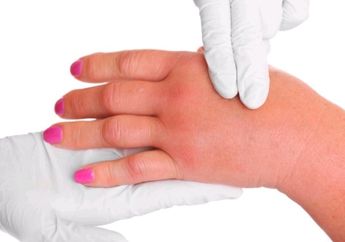 Awas! Ini Beberapa Alasan Kesehatan yang Sebabkan Jari-jarimu Bisa Membengkak