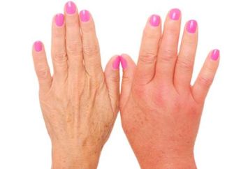 Dari Suhu Panas Hingga Komplikasi, Inilah Deretan Sebab Jari Membengkak, Salah Satunya Penyakit Bahaya nih?
