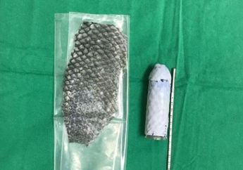 Lahir Tanpa Miss V, Wanita Ini Jalani Operasi Rekonstruktif dengan Kulit Ikan, Kaya Gimana tuh?